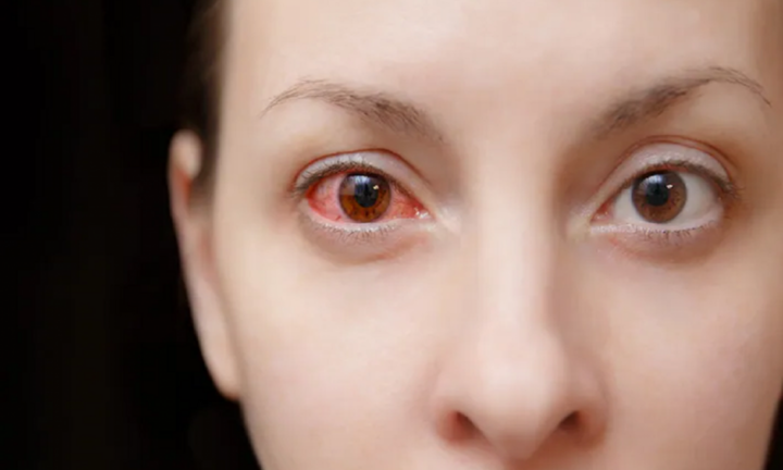 Những bệnh nhiễm trùng mắt liên quan đến COVID-19