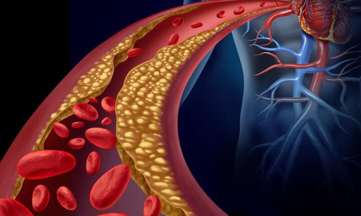 Dấu hiệu trên mặt cho thấy cholesterol 'vượt ngưỡng', cảnh báo bệnh tim đến gần