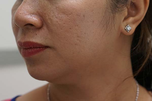 Mờ sẹo Bảo Liễu - Serum hỗ trợ làm đầy sẹo rỗ dành riêng cho phái đẹp