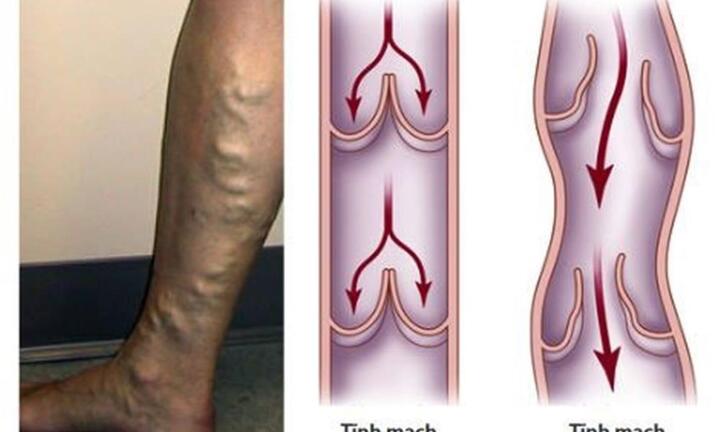 Mỏi chân và các dấu hiệu cảnh báo suy tĩnh mạch chi dưới ở phụ nữ