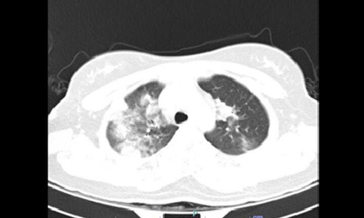 Cô gái 18 tuổi bị viêm phổi nặng sau một tháng khỏi COVID-19 