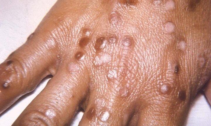 Bệnh đậu mùa khỉ lây lan qua những đường nào?