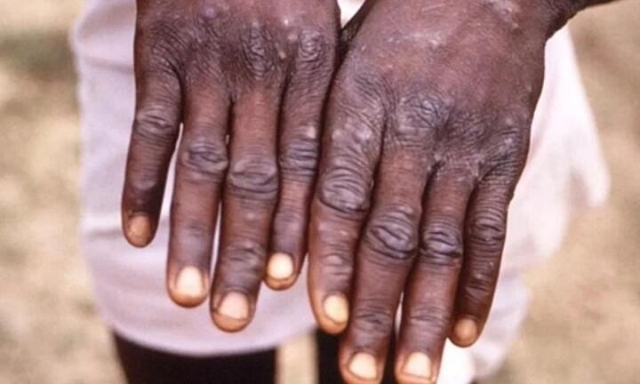 Các nước 'đổ xô' tích trữ vaccine đậu mùa khỉ