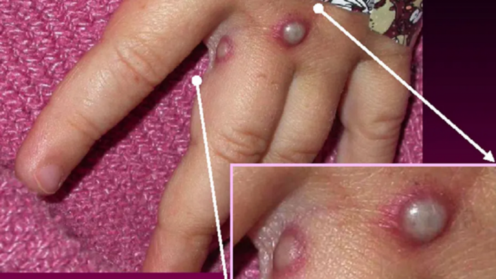 Đậu mùa khỉ: Phòng bệnh thế nào và cần làm gì nếu mắc bệnh?