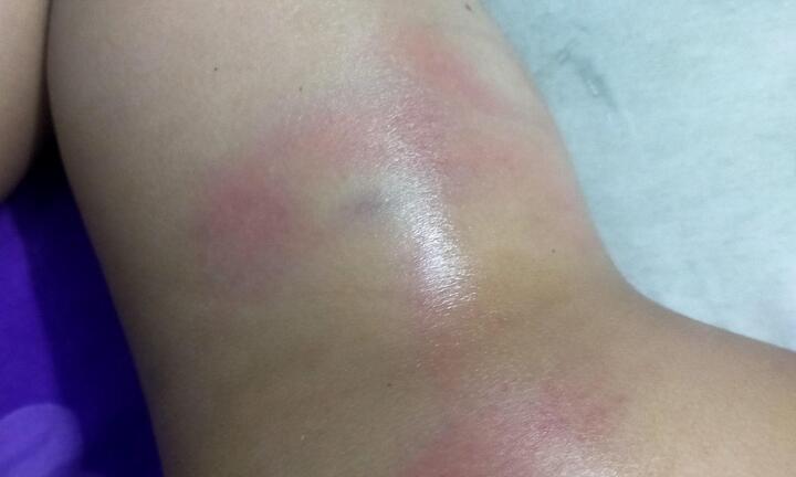 Bình Dương: Bé gái 4 tuổi nghi bị cô giáo đánh bầm tím cả cơ thể