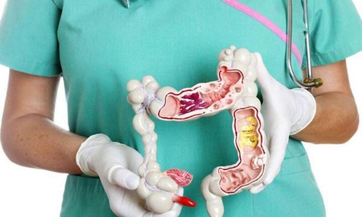 5 triệu chứng ung thư đại tràng giai đoạn cuối