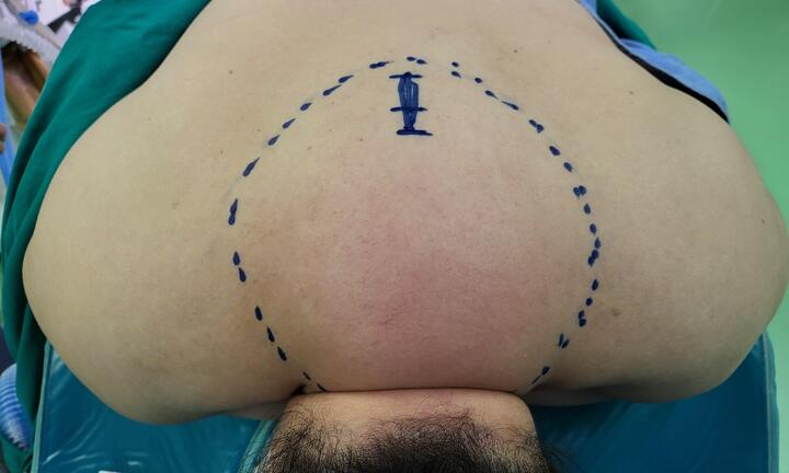 Tưởng béo, đi khám mới biết mắc bệnh hiếm gặp