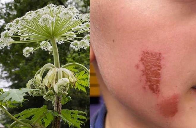 Cây 'sứ giả địa ngục' khiến bé trai bỏng mặt chỉ sau cú chạm nhẹ