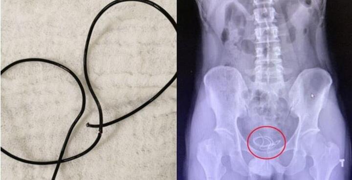 Nghịch dại vì muốn tạo khoái cảm, nam thanh niên phải nhập viện