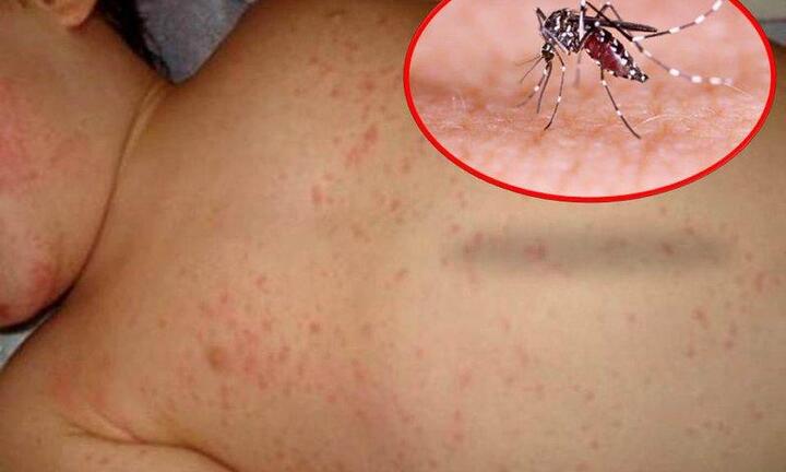 Hai bệnh nhi sốt xuất huyết nặng có yếu tố dịch tễ phía Nam