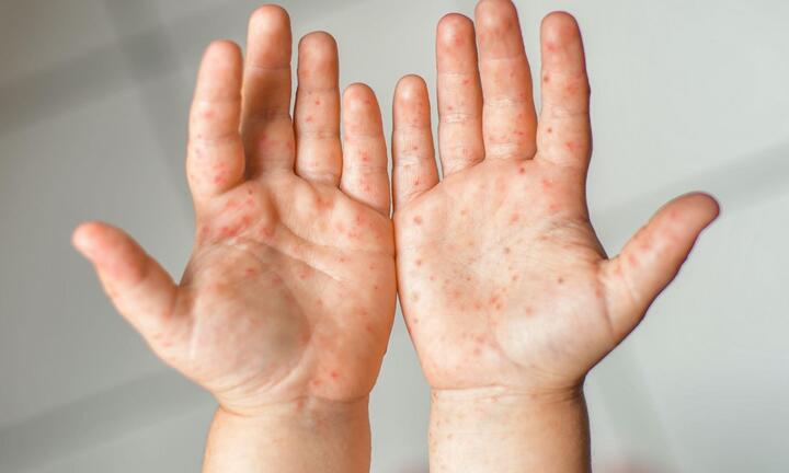 Nhiều trẻ nguy kịch vì bệnh tay chân miệng