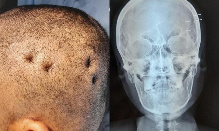 Người đàn ông ở Tây Ninh tự bắn 4 cây đinh vào đầu