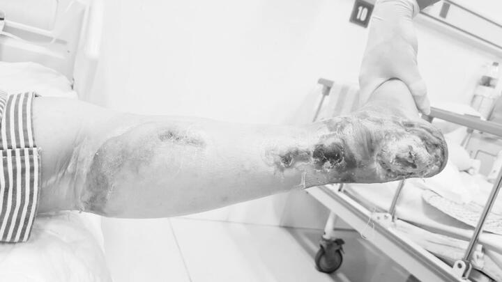Người phụ nữ phải cắt cụt chân do căn bệnh nhiều người Việt mắc phải