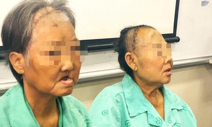 Hoại tử xương hàm mặt hậu COVID-19: Không phải bệnh lạ