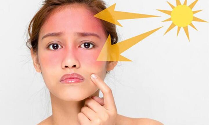 4 nhóm người cực kỳ dễ cháy nắng, thậm chí cả khi mát trời