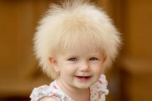 Em bé mắc hội chứng lạ, mái tóc khiến nhiều người thích thú