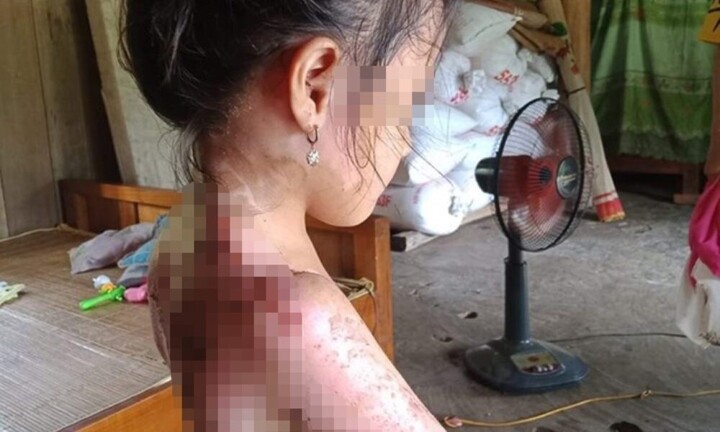 Nghi ngờ chồng ngoại tình, người phụ nữ tạt nước sôi vào 3 mẹ con hàng xóm