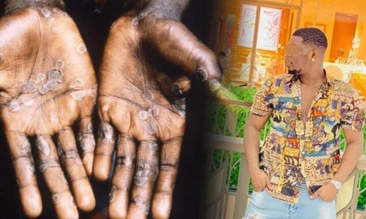 Người mắc bệnh đậu mùa khỉ đầu tiên tại Thái Lan trốn sang Campuchia