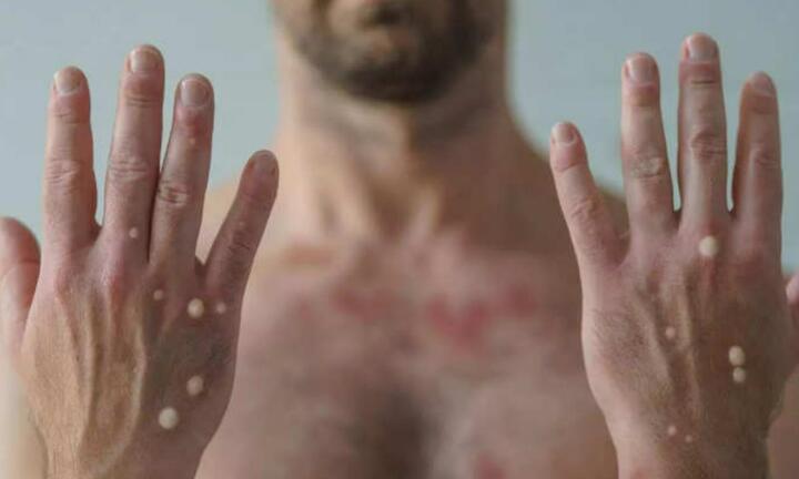 Phân biệt nốt phát ban đậu mùa khỉ với thủy đậu