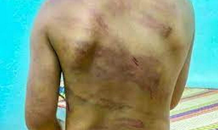 Bé 7 tuổi nghi bị bạo hành ở Bình Phước đã được đưa đi điều trị 