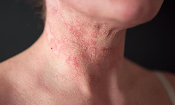 Sáu chất bổ sung cần thiết khi mắc bệnh chàm ngứa