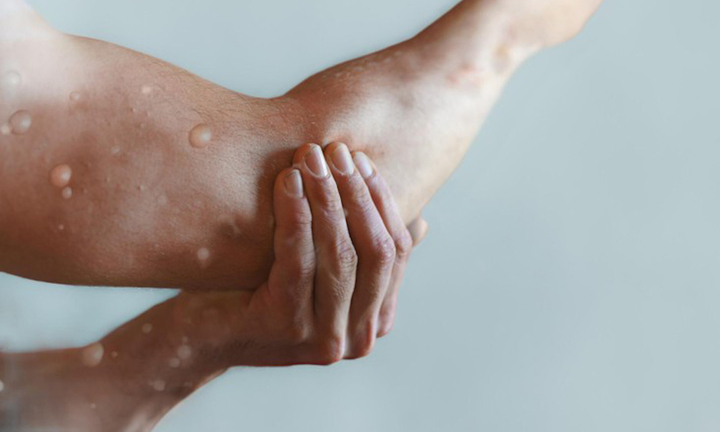 Việt Nam nghiên cứu sản xuất thuốc chữa bệnh đậu mùa khỉ