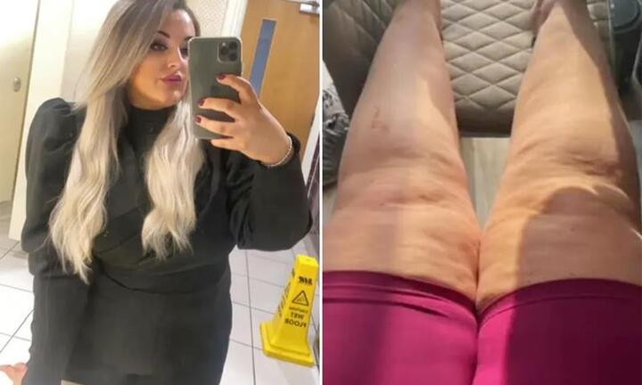 Căn bệnh khiến người phụ nữ tăng 44 kg dù chỉ ăn một bữa mỗi ngày