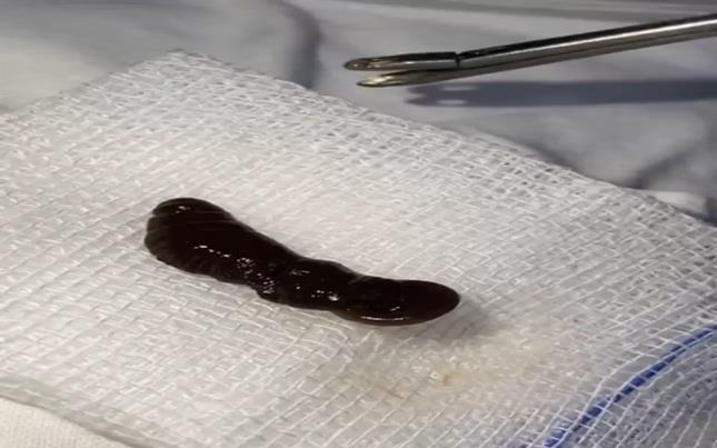 Con vắt sống trong mũi bé trai 18 tháng tuổi