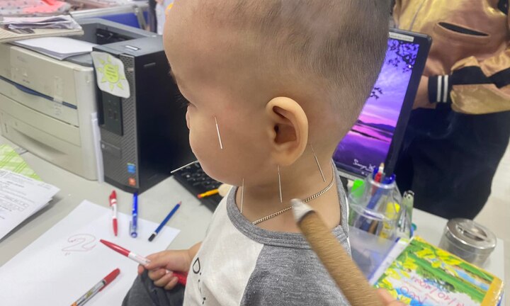 Bé 1 tuổi liệt mặt do nằm quạt