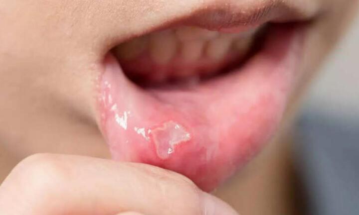 Dấu hiệu này trên lưỡi chứng tỏ bạn thiếu vitamin B12