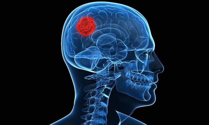 Đau đầu dữ dội, nam thanh niên Hà Nội đi khám mới biết có u khổng lồ trong sọ 