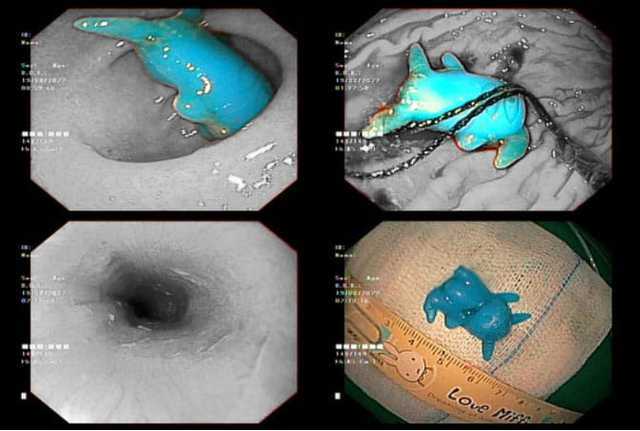 Pikachu đồ chơi kẹt trong thực quản bé 6 tuổi