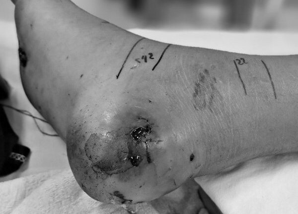 Tự ý đắp lá chữa rắn cắn, bé trai nhiễm trùng nặng