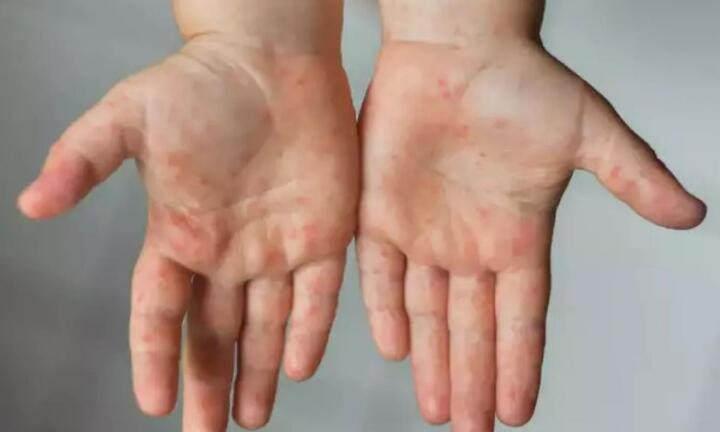 Phân biệt bệnh đậu mùa khỉ và cúm cà chua 