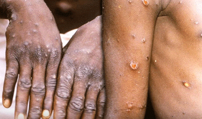 Mỹ xác nhận ca tử vong đầu tiên do đậu mùa khỉ