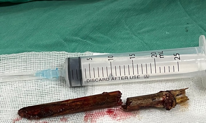 Phú Thọ: Cứu sống nam thanh niên bị tre đâm xuyên cổ