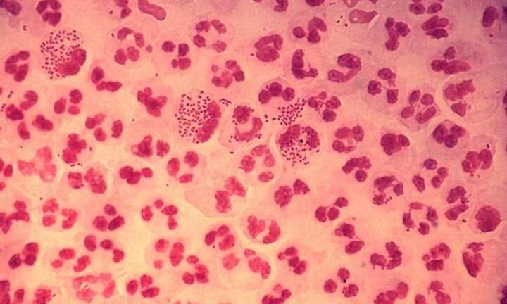 Tưởng viêm kết mạc, nam thanh niên hốt hoảng phát hiện bệnh lậu ở mắt