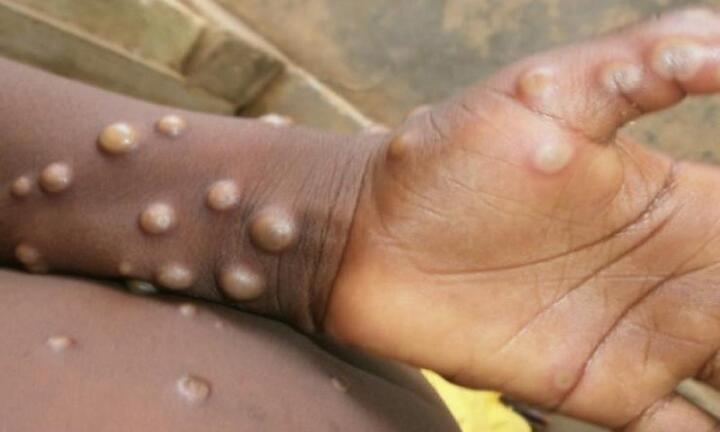Mỹ cảnh báo đậu mùa khỉ có thể biến đổi chống thuốc kháng virus