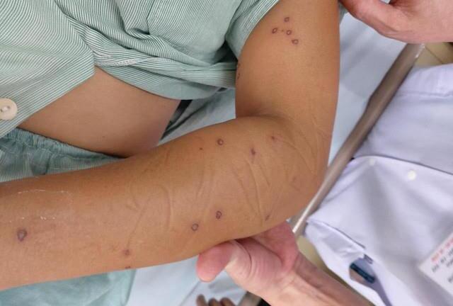 Bị ong vò vẽ đốt 70 nốt, người phụ nữ trẻ nguy kịch 
