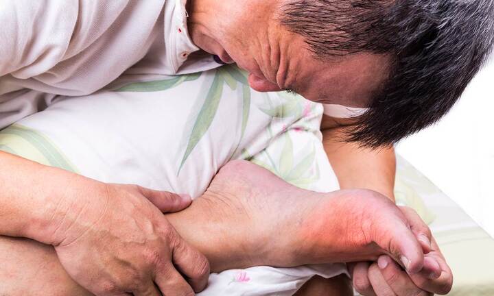 Bị gout ở tuổi 26