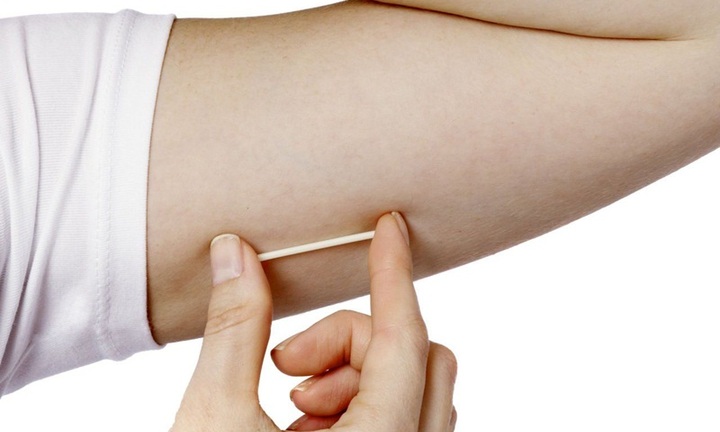 Que tránh thai 'đi lạc' sâu vào cơ bắp tay người phụ nữ