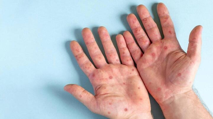 Cần làm gì khi nghi ngờ nhiễm đậu mùa khỉ?