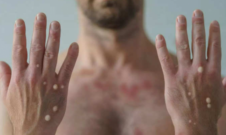 Đậu mùa khỉ có phải là bệnh lây qua đường tình dục?