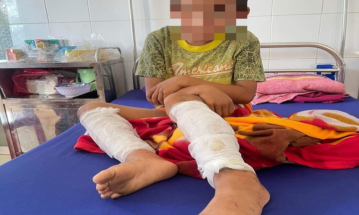  Cháu bé lớp 3 bị cha đốt bằng xăng và rơm ở Quảng Bình