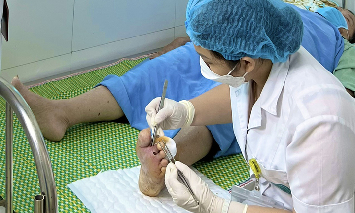 Tự đắp thuốc kháng sinh chữa đái tháo đường, một người phải tháo bỏ ngón chân