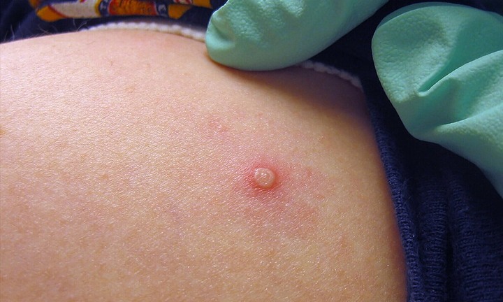 Bác sĩ chỉ ra cách ngăn chặn đường lây lan của đậu mùa khỉ