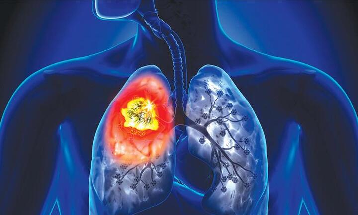 Phát hiện ung thư phổi di căn khi đi khám đau mỏi vai, cổ
