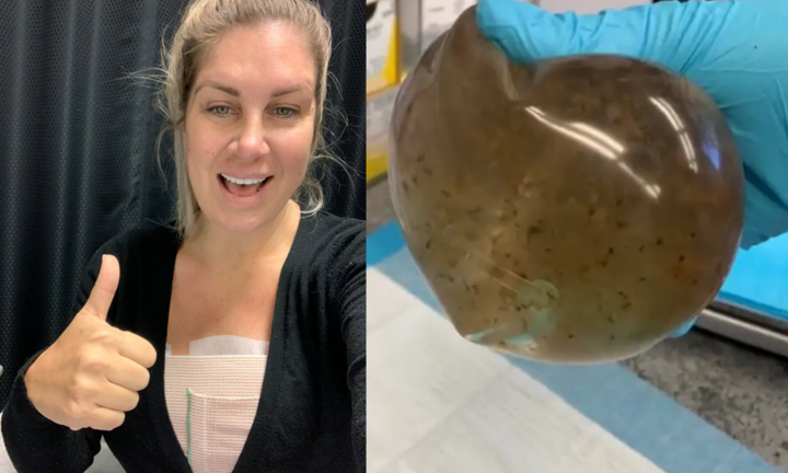 Tháo túi nâng ngực sau 8 năm mắc bệnh không rõ lý do, sốc khi thấy thứ bên trong