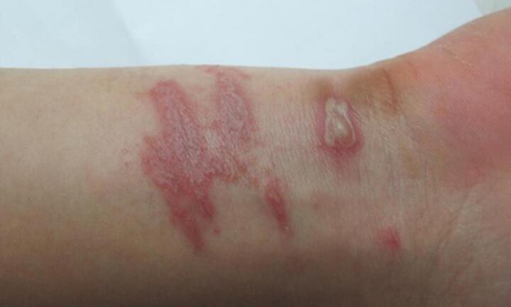 Nhiều người nhập viện do kiến ba khoang: Chuyên gia chỉ rõ sai lầm khi điều trị