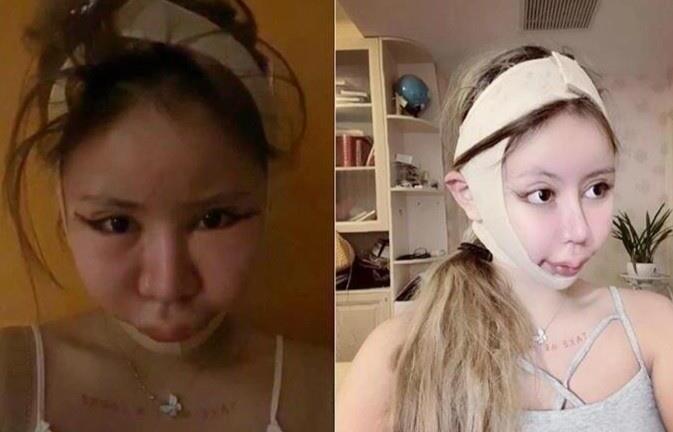 Bé gái 9 tuổi bị mẹ đẻ ép cắt mí, làm mũi, nâng ngực